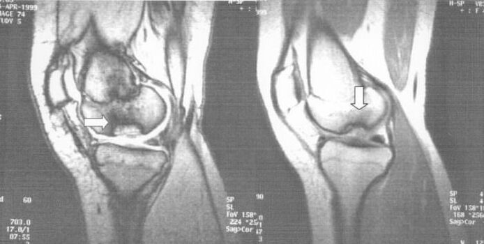 Radiographie de l'ostéochondrose disséquante dans l'articulation du genou