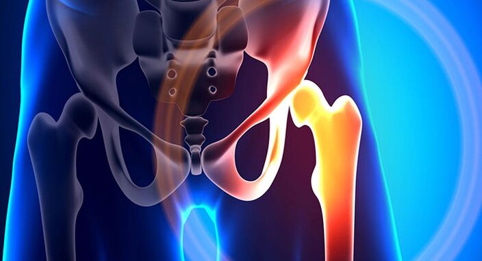 La douleur à la hanche est un symptôme de nombreuses affections différentes