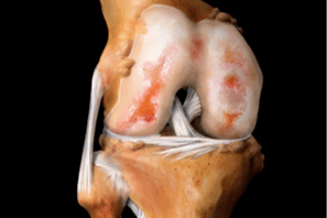 dommages à l'articulation du genou dus à l'arthrose